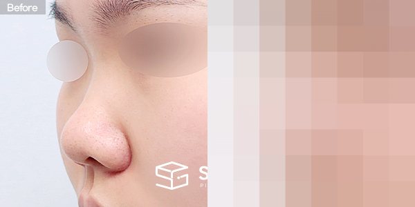 슈가성형외과 첫) 콧대 + 코끝 + 콧볼축소 + 복코 + 자가늑 전후사진 - 정면 수술 전후 비교