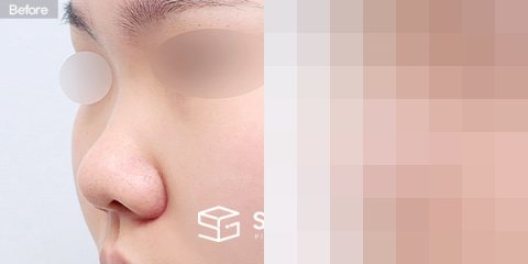 슈가성형외과 첫) 콧대 + 코끝 + 콧볼축소 + 복코 + 자가늑 전후사진 - 정면 수술 전후 비교
