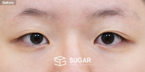 슈가성형외과 첫) 절개 + 눈매교정 + 앞트임 + 윗트임 전후사진 - 수술 전