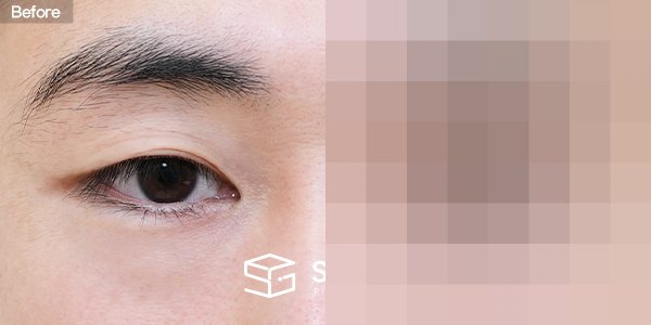 슈가성형외과 재) 재수술 + 자연유착 + 눈매교정 전후사진 - 정면 수술 전후 비교