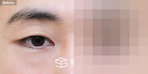 슈가성형외과 재) 재수술 + 자연유착 + 눈매교정 전후사진 - 정면 수술 전후 비교