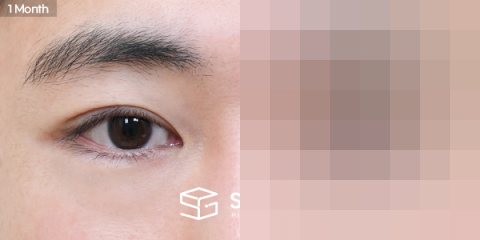 슈가성형외과 재) 재수술 + 자연유착 + 눈매교정 전후사진 - 45도 수술 전후 비교