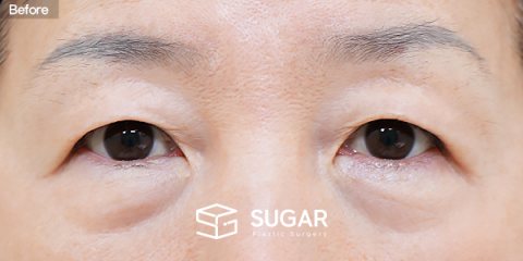 슈가성형외과 첫) 눈썹하거상술 + 하안검 전후사진 - 수술 전