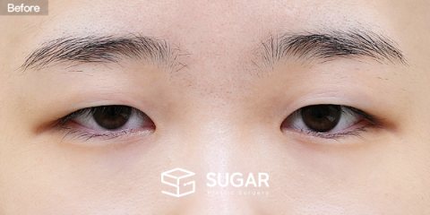 슈가성형외과 첫) 자연유착 + 눈매교정 + 윗트임 + 눈 두덩이 지방 제거 전후사진 - 수술 전