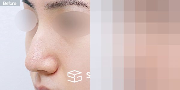 슈가성형외과 첫) 무보형물 + 매부리 + 비중격연장 + 귀 뒤 근막 + 귀연골 전후사진 - 정면 수술 전후 비교