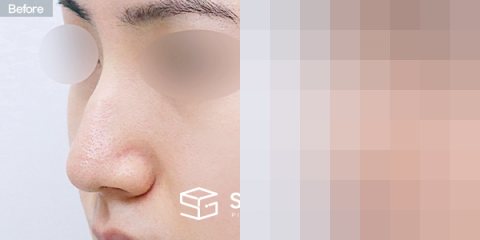슈가성형외과 첫) 무보형물 + 매부리 + 비중격연장 + 귀 뒤 근막 + 귀연골 전후사진 - 정면 수술 전후 비교