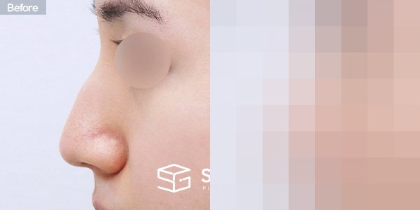 슈가성형외과 첫) 무보형물 + 매부리 + 비중격연장 + 귀 뒤 근막 + 귀연골 전후사진 - 45도 수술 전후 비교