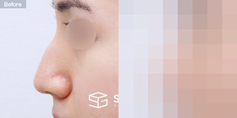 슈가성형외과 첫) 무보형물 + 매부리 + 비중격연장 + 귀 뒤 근막 + 귀연골 전후사진 - 45도 수술 전후 비교