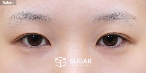 슈가성형외과 첫) 뒤밑트임 전후사진 - 수술 전