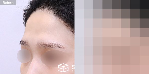 슈가성형외과 첫) 이마필러 전후사진 - 정면 수술 전후 비교