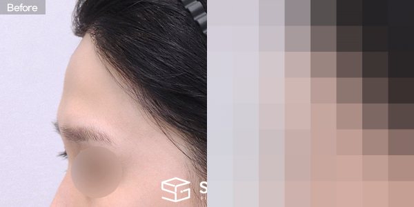 슈가성형외과 첫) 이마필러 전후사진 - 45도 수술 전후 비교