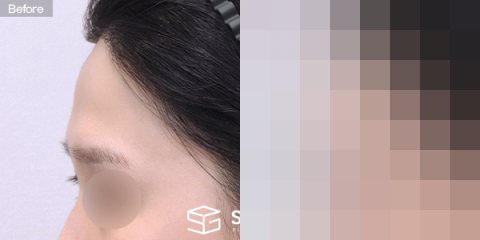 슈가성형외과 첫) 이마필러 전후사진 - 45도 수술 전후 비교