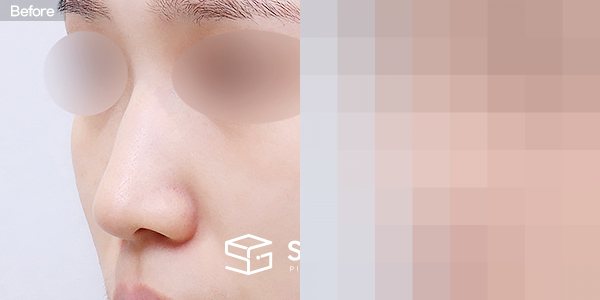 슈가성형외과 첫) 무보형물 + 절골 + 매부리 + 복코 + 귀 뒤 근막 + 귀연골 + 비중격연장 전후사진 - 정면 수술 전후 비교