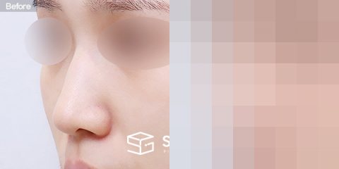 슈가성형외과 첫) 무보형물 + 절골 + 매부리 + 복코 + 귀 뒤 근막 + 귀연골 + 비중격연장 전후사진 - 정면 수술 전후 비교