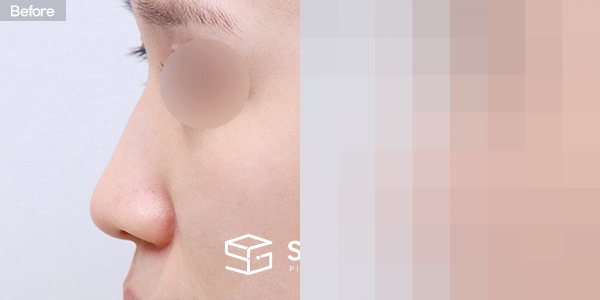 슈가성형외과 첫) 무보형물 + 절골 + 매부리 + 복코 + 귀 뒤 근막 + 귀연골 + 비중격연장 전후사진 - 45도 수술 전후 비교