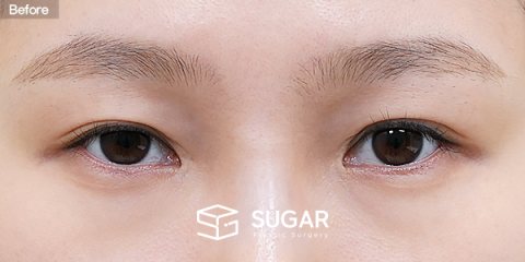슈가성형외과 재) 재수술 + 자연유착 + 눈매교정 + 뒤밑트임 전후사진 - 수술 전