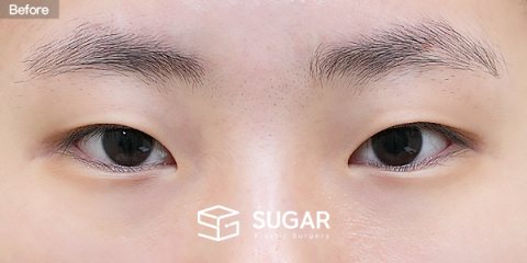 슈가성형외과 첫) 절개 + 눈매교정 + 앞트임 + 뒤밑트임 전후사진 - 수술 전