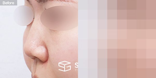슈가성형외과 첫) 무보형물 + 자가늑 + 귀연골 + 복코 + 비주연장 + 비순각교정 + 절골 + 매부리 + 귀 뒤 근막 전후사진 - 정면 수술 전후 비교