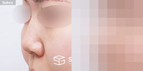 슈가성형외과 첫) 무보형물 + 자가늑 + 귀연골 + 복코 + 비주연장 + 비순각교정 + 절골 + 매부리 + 귀 뒤 근막 전후사진 - 정면 수술 전후 비교