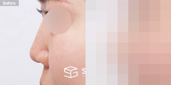 슈가성형외과 첫) 무보형물 + 자가늑 + 귀연골 + 복코 + 비주연장 + 비순각교정 + 절골 + 매부리 + 귀 뒤 근막 전후사진 - 45도 수술 전후 비교