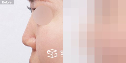 슈가성형외과 첫) 무보형물 + 자가늑 + 귀연골 + 복코 + 비주연장 + 비순각교정 + 절골 + 매부리 + 귀 뒤 근막 전후사진 - 45도 수술 전후 비교