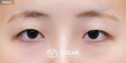 슈가성형외과 첫) 자연유착 + 앞트임 + 윗트임 전후사진 - 수술 전