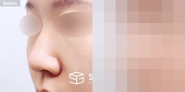 슈가성형외과 첫) 무보형물 + 비중격연골 + 귀연골 + 복코 + 귀 뒤 근막 + 절골 + 콧볼축소 전후사진 - 정면 수술 전후 비교