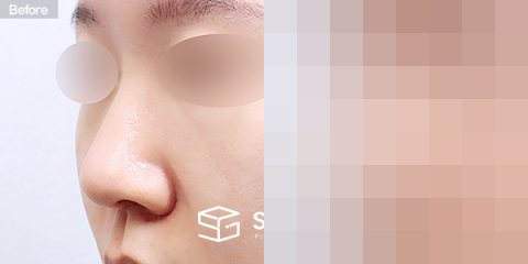 슈가성형외과 첫) 무보형물 + 비중격연골 + 귀연골 + 복코 + 귀 뒤 근막 + 절골 + 콧볼축소 전후사진 - 정면 수술 전후 비교