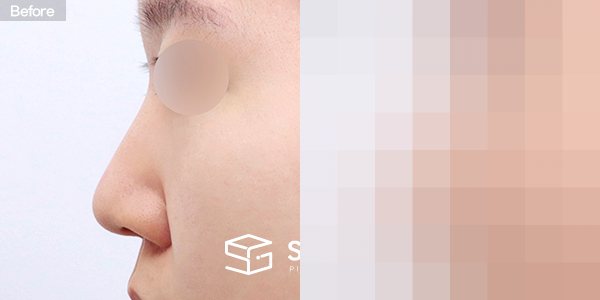 슈가성형외과 첫) 무보형물 + 비중격연골 + 귀연골 + 복코 + 귀 뒤 근막 + 절골 + 콧볼축소 전후사진 - 45도 수술 전후 비교