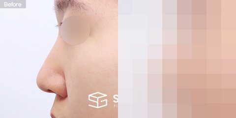 슈가성형외과 첫) 무보형물 + 비중격연골 + 귀연골 + 복코 + 귀 뒤 근막 + 절골 + 콧볼축소 전후사진 - 45도 수술 전후 비교