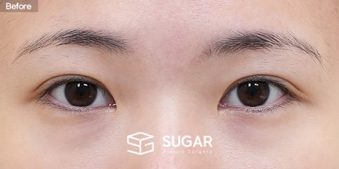 슈가성형외과 재) 뒤트임 재수술 + 밑트임 + 눈밑지방재배치 전후사진 - 수술 전
