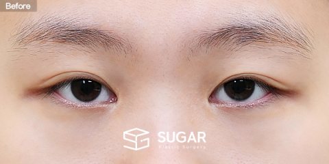 슈가성형외과 재) 재수술 + 절개 + 눈매교정 + 뒤밑트임 전후사진 - 수술 전