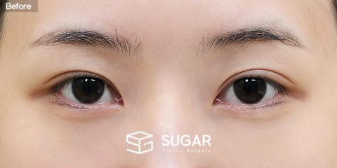 슈가성형외과 첫) 비절개눈매교정 + 윗트임 + 웨이브뒤밑트임 전후사진 - 수술 전