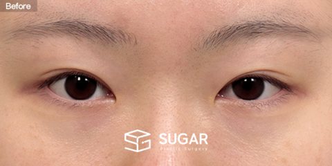 슈가성형외과 첫) 비절개눈매교정 + 윗트임 + 웨이브뒤밑트임 전후사진 - 수술 전