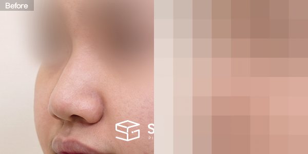 슈가성형외과 첫) 무보형물 + 귀연골 + 복코교정 + 절골 + 비주연장 + 콧볼축소 전후사진 - 정면 수술 전후 비교