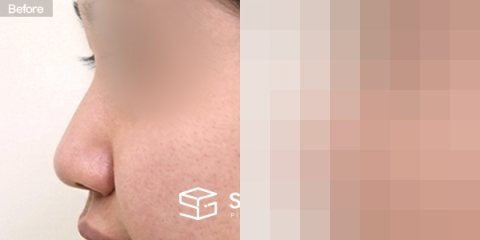 슈가성형외과 첫) 무보형물 + 귀연골 + 복코교정 + 절골 + 비주연장 + 콧볼축소 전후사진 - 45도 수술 전후 비교
