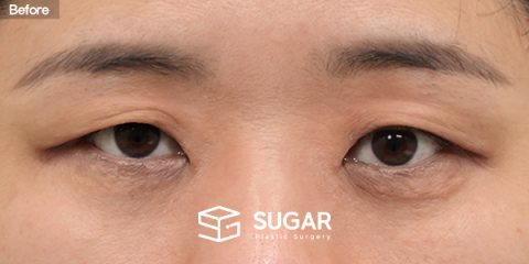 슈가성형외과 첫) 눈썹 거상 + 자연유착 + 윗트임 전후사진 - 수술 전