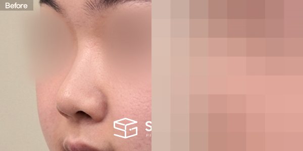 슈가성형외과 첫) 콧대 + 코끝 + 자가늑 + 복코교정 + 콧볼축소 전후사진 - 정면 수술 전후 비교
