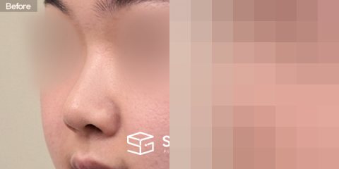 슈가성형외과 첫) 콧대 + 코끝 + 자가늑 + 복코교정 + 콧볼축소 전후사진 - 정면 수술 전후 비교
