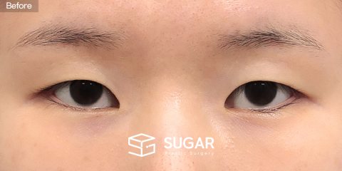 슈가성형외과 첫) 비절개눈매교정 + 앞트임 전후사진 - 수술 전