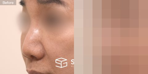 슈가성형외과 첫) 콧대실리콘 + 코끝기증늑 + 복코교정 + 콧볼축소 + 절골 전후사진 - 정면 수술 전후 비교
