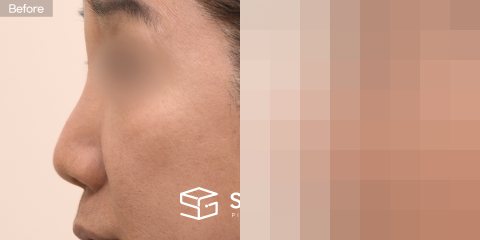 슈가성형외과 첫) 콧대실리콘 + 코끝기증늑 + 복코교정 + 콧볼축소 + 절골 전후사진 - 45도 수술 전후 비교