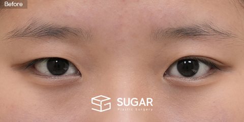 슈가성형외과 첫) 비절개눈매교정 + 앞트임 전후사진 - 수술 전