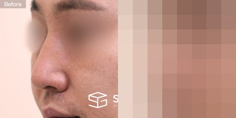 슈가성형외과 첫) 무보형물코성형 + 귀연골 + 비중격연골 + 절골 + 휜코교정 + 복코교정 전후사진 - 정면 수술 전후 비교