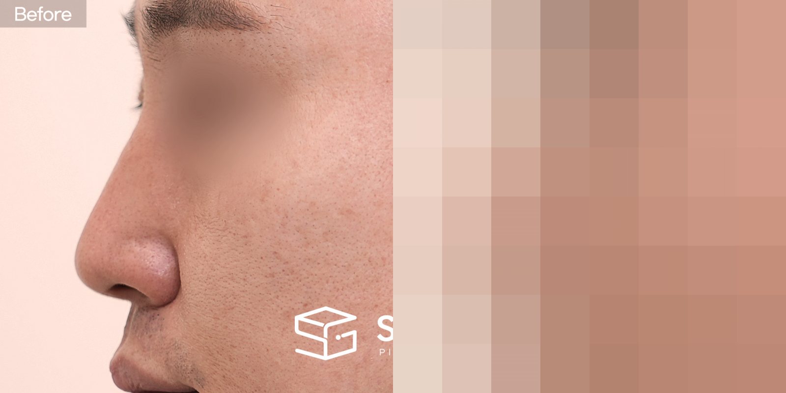 슈가성형외과 첫) 무보형물코성형 + 귀연골 + 비중격연골 + 절골 + 휜코교정 + 복코교정 전후사진 - 45도 수술 전후 비교