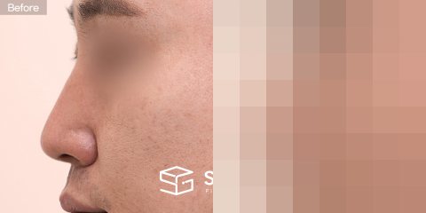 슈가성형외과 첫) 무보형물코성형 + 귀연골 + 비중격연골 + 절골 + 휜코교정 + 복코교정 전후사진 - 45도 수술 전후 비교