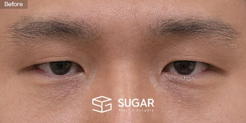 슈가성형외과 첫) 눈썹거상술 + 매몰쌍꺼풀 + 눈매교정 전후사진 - 수술 전