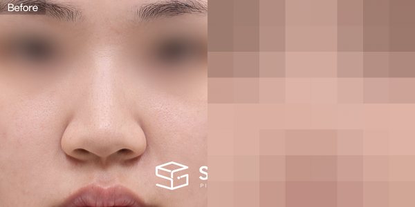 슈가성형외과 첫) 콧대(귀뒤근막) + 코끝(귀연골) + 연골이식 + 복코교정 + 콧볼축소 전후사진 - 정면 수술 전후 비교
