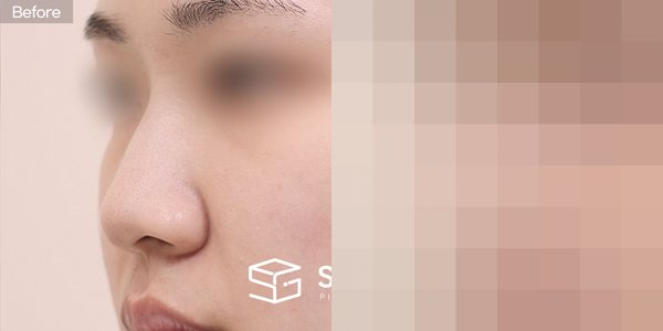 슈가성형외과 첫) 콧대(귀뒤근막) + 코끝(귀연골) + 연골이식 + 복코교정 + 콧볼축소 전후사진 - 45도 수술 전후 비교