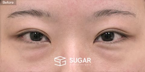 슈가성형외과 첫) 뒤트임 + 밑트임 + 눈밑지방재배치 전후사진 - 수술 전